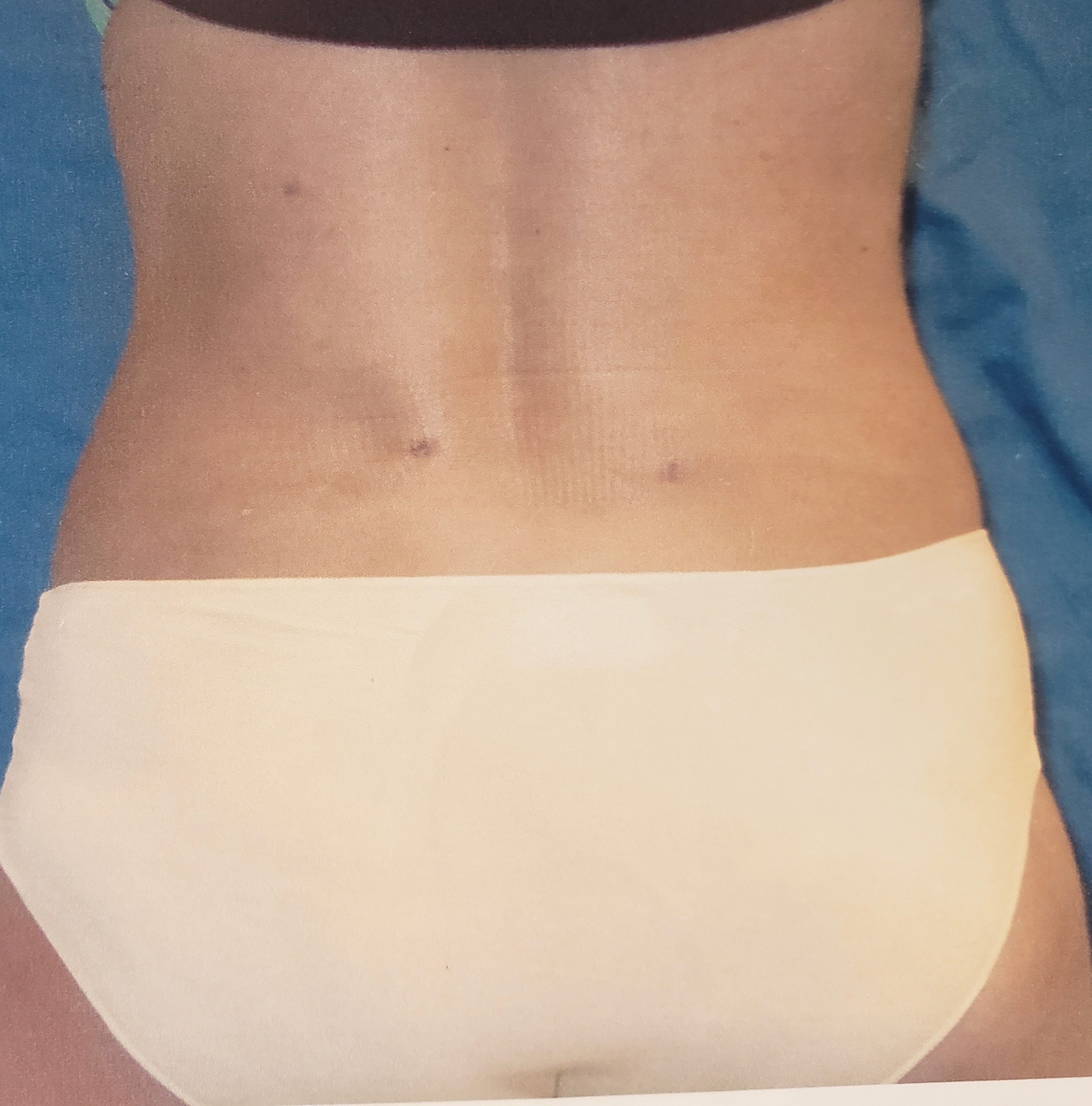 Liposuction of Flanks Before and After 3804